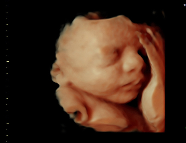 3D ultrasound image at 31 weeks